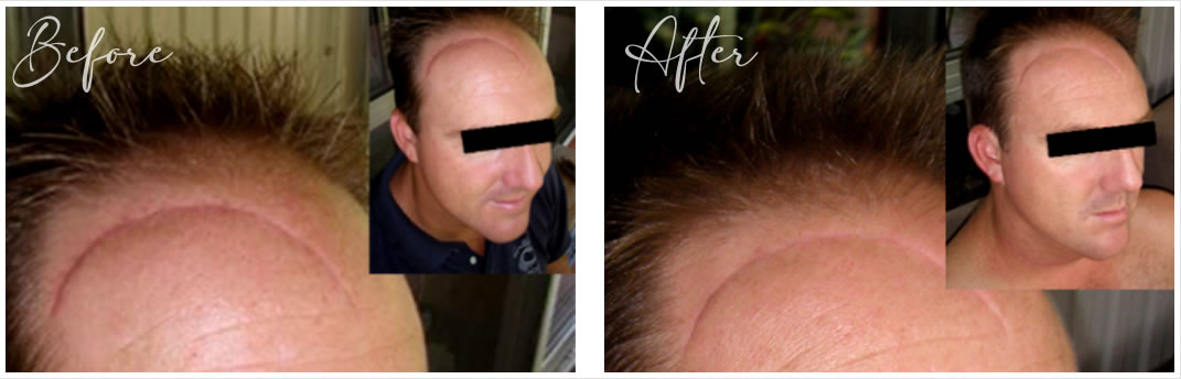 Microdermabrasion before and after shots