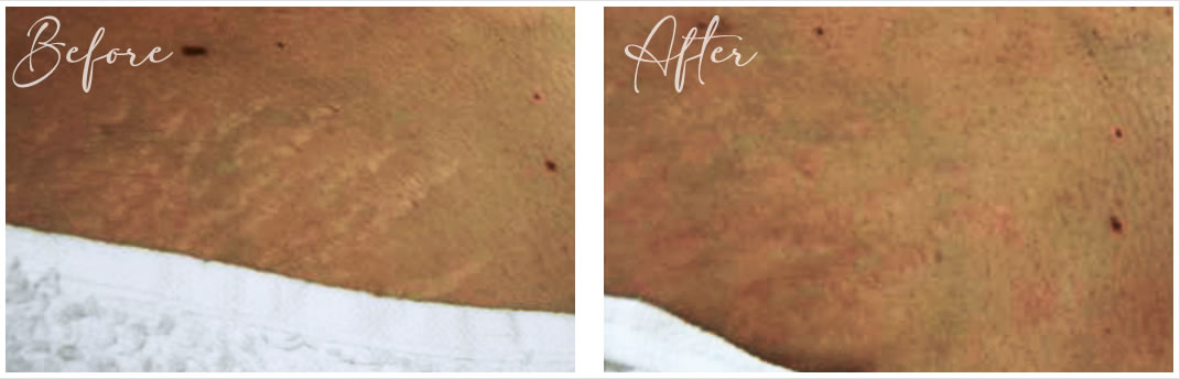 Microdermabrasion before and after shots